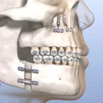 Visit Bradenton Orthodontics jaw surgery