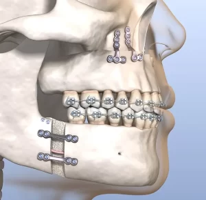 Visit Bradenton Orthodontics jaw surgery