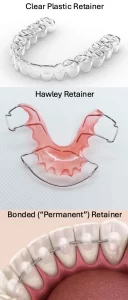 Visit Bradenton Orthodontics retainers